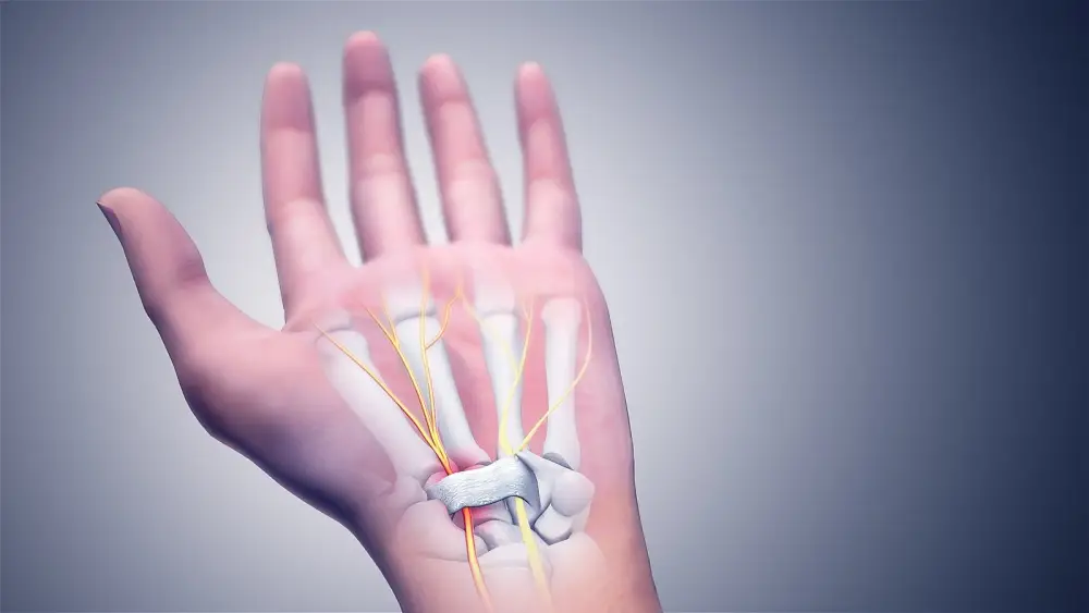 Karpal Tünel Sendromu